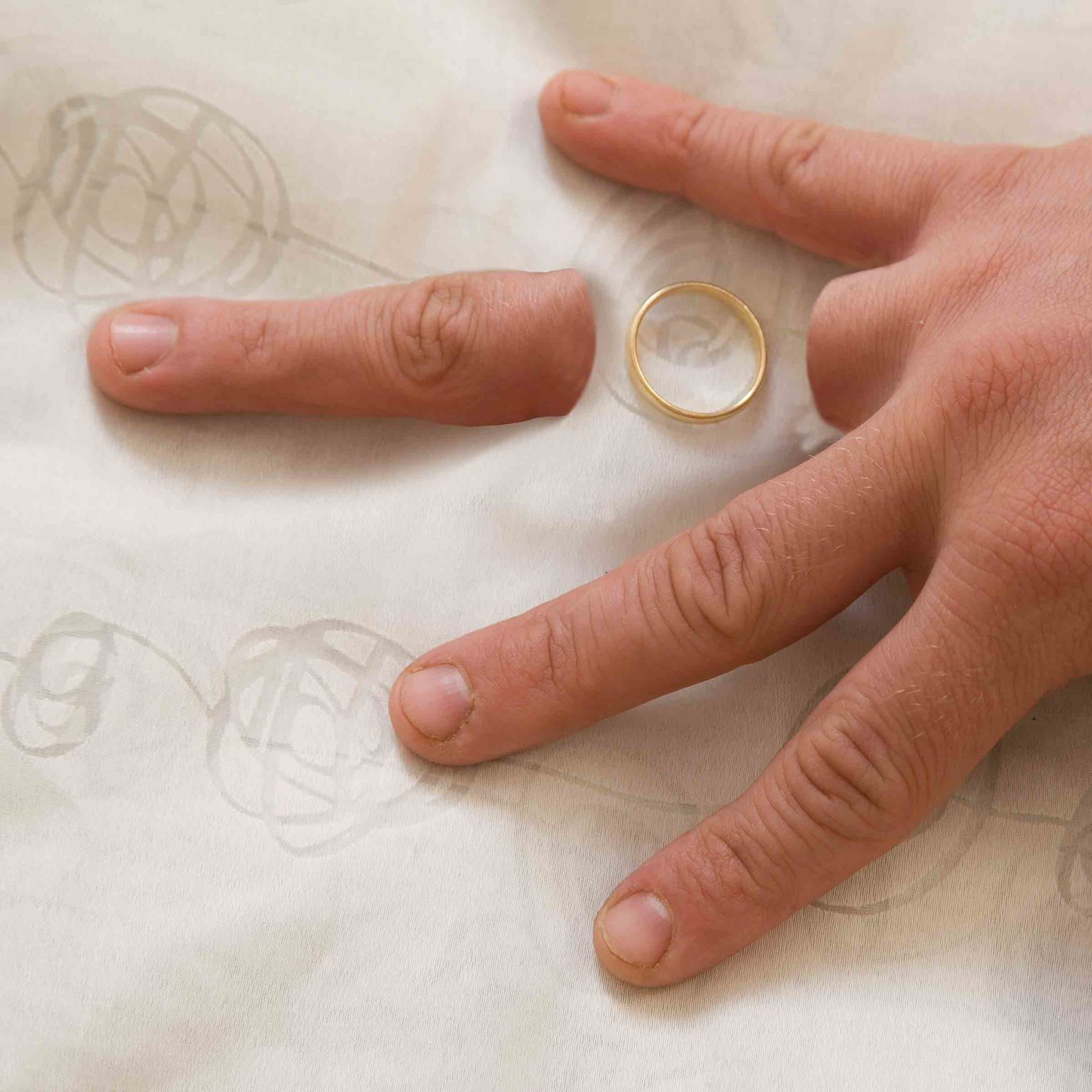 Открыть пальчика. Отрывание пальца кольцом. Обручальное кольцо оторвало палец. Оторванные пальцы от обручального кольца.